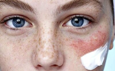 Šta je osetljiva koža i kako je prepoznati