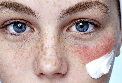 Šta je osetljiva koža i kako je prepoznati